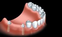 Ti Dental image 6